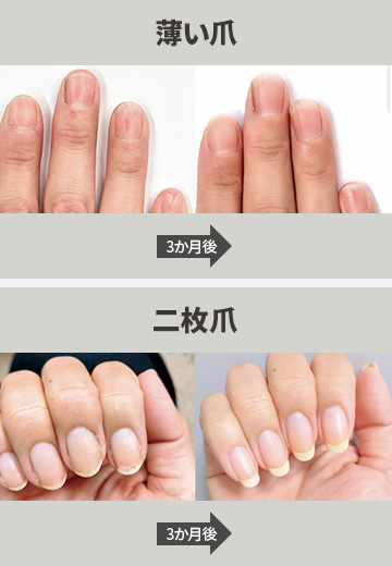 薄い爪、二枚爪